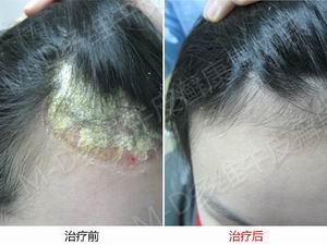郑州牛皮癣治疗
