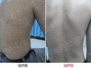 郑州牛皮癣医院