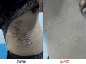 郑州牛皮癣治疗专科医院