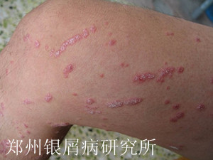 牛皮癣如何治疗更好