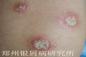 牛皮癣症状