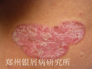 牛皮癣治疗