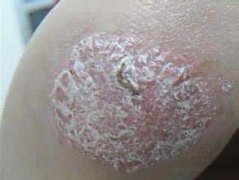 牛皮癣的危害大,及时诊断很重要