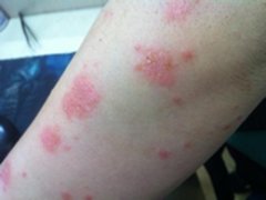 功能障碍易诱发牛皮癣吗
