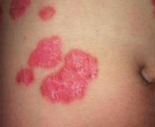 银屑病患者该怎么护理